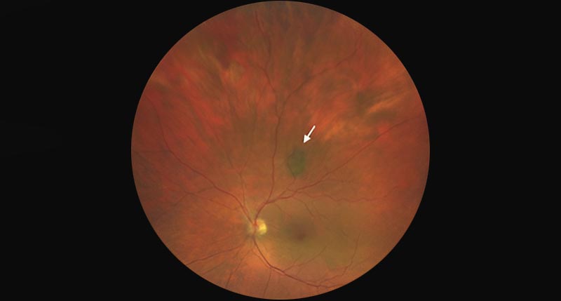 eye freckle adult pediatric eyecare local eye doctor near you.jpg